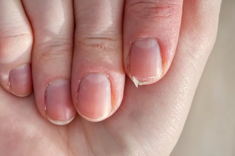Eggshell Nails Top Causes and Effective Solutions for Hapalonychia Eggshell Nails